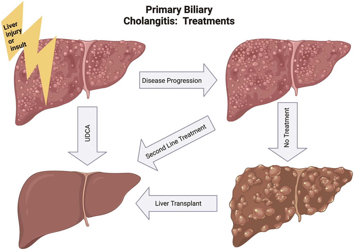 Primary sclerosing cholangitis (PSC) Treatment in India
